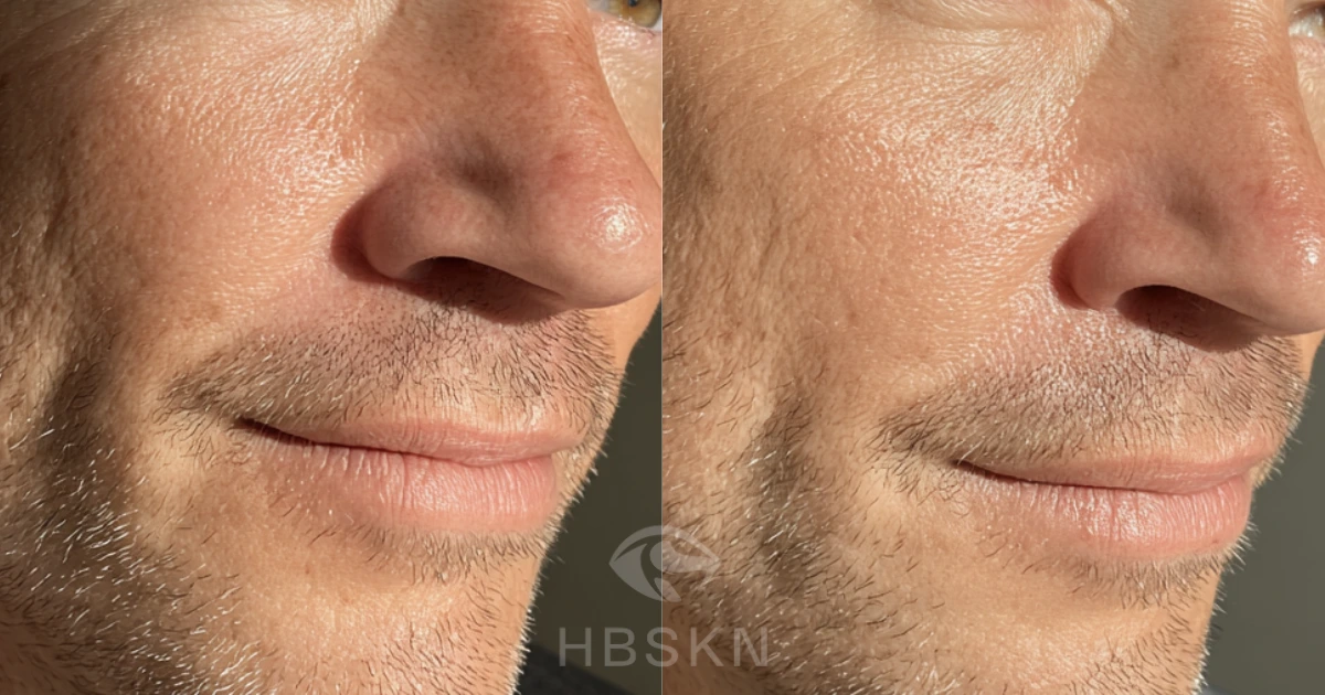 Irritazione rasatura